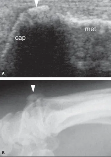 Figure 4. Carpal boss (mixed presentation). A: Longitudinal image demonstrating the capitate bone (cap), the metacarpal bone (met) and the osteophyte on the carpal margin of the carpometacarpal joint (arrow)