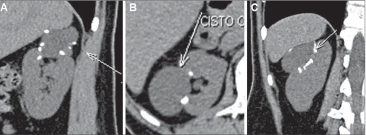 Figure 6. Bosniak category III. MDCT images axial (A), coronal (B) and sagittal (C) reconstructions identifying a cystic lesion in the left kidney, with thin septum and septal calcifications (arrows on B)