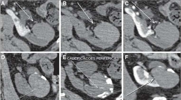 Figure 7. Bosniak category III. MDCT images, axial (A,B,C,E) and coronal (D,B) demonstrating a hyperattenuating mass in the left kidney, with peripheral Gross calcifications (arrow on E)
