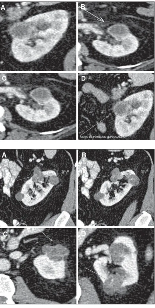 Figure 8. Bosniak category IV. MDCT images, sagittal (A,D) and axial (B,C) reconstructions  dem-onstrating a cystic lesion with gross and nodular parietal thickening.