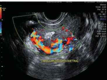 Figure 3. Transvaginal color Doppler US demonstrating intense myometrial hypervascularization with turbulent flow.