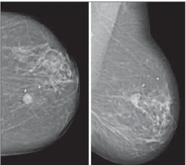 Figure 1. Mammography, craniocaudal and oblique views. An ovoid well defined mass is identified in the upper-inner quadrant of the left breast, with medium density and no associated microcalcifications.