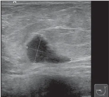 Figure 2. Ultrasonography demonstrated a solid hypoechogenic mass with ill defined contours, without any alteration of posterior echoes, measuring 19 mm in its largest diameter.