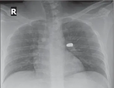Figure 4. Pulmonary arteriography with selective characterization of left pulmo- pulmo-nary artery demonstrates decreased blood flow toward the lingular segment of the left upper pulmonary lobe.
