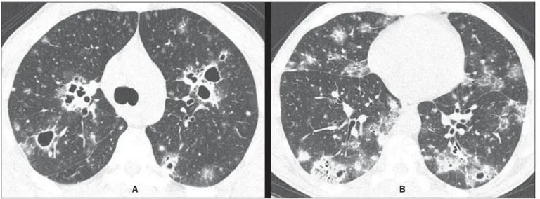 Figure 1. Chest high-resolution CT at the level of the carina (A) and lower lobes (B).