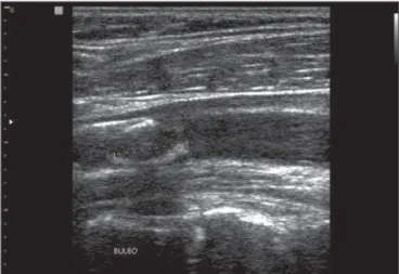 Figure 2. Carotid artery calcification detected at ultrasonography.