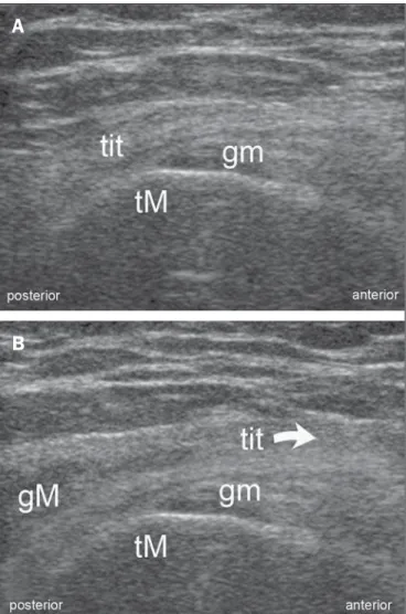 Figure 1. Proximal iliotibial band syndrome. Female, 27-year-old patient, profes- profes-sional athlete, presenting with focal pain adjacent to the right iliac crest that  inten-sifies during physical activity