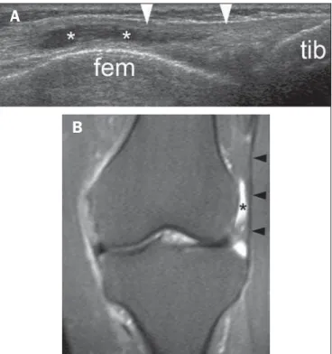 Figure 3. Early stage of iliotibial band syndrome. Male, 37-year-old patient, ama- ama-teur cyclist, presenting with pain in the lateral aspect of his knee that intensifies during physical activity