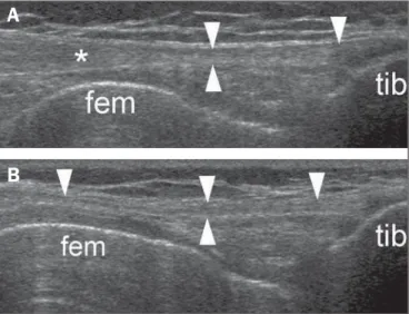 Figure 7. Insertional iliotibial band tendinosis. Male, 89-year-old, sedentary pa- pa-tient, presents with pain epicenter in the lateral aspect of his knee, with proximal irradiation, with no apparent motive