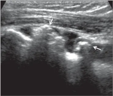 Figure 2. Secondary synovial osteochondromatosis. Sonographic study of the shoulder focusing the tendon of the biceps long head (TBLH) on the transverse plane