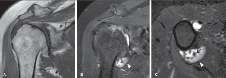 Figure 5. Secondary synovial osteochondromatosis. Magnetic resonance imaging, T1-weighted sequence of the shoulder in the coronal plane (A), coronal T2-weighted fat sat (B), and axial T2weighted fat sat (C) demonstrating marked osteodegenerative glenohumer