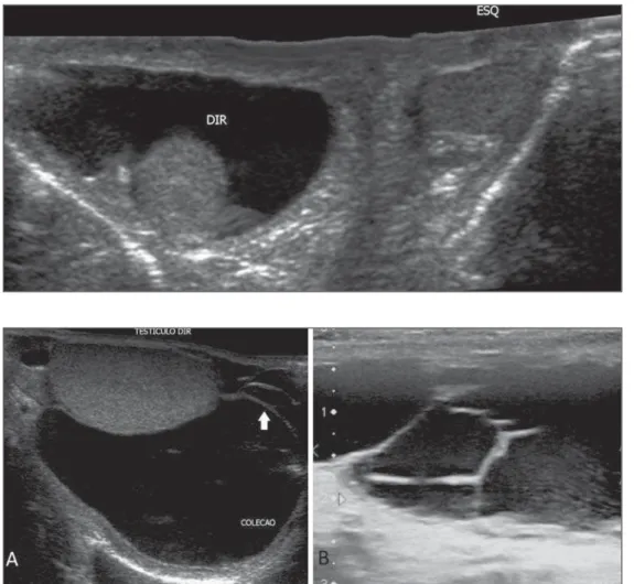Figure 1. B-mode US image with ex- ex-tended field of view in a neonate:  homo-geneous hydrocele at right, and usual aspect of the left scrotum