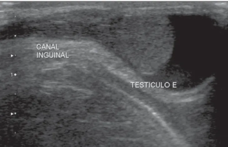 Figure 4. Congenital hydrocele. B-mode US image of an one-month-old infant: