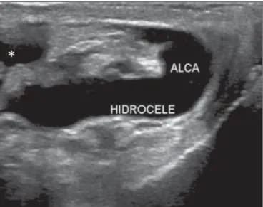 Figure 7. Inguinal hernia associated with hydrocele. B-mode US showing an ir- ir-regular mass with thickened walls, containing a small amount of fluid, and  sur-rounded by free fluid with anechoic appearance.