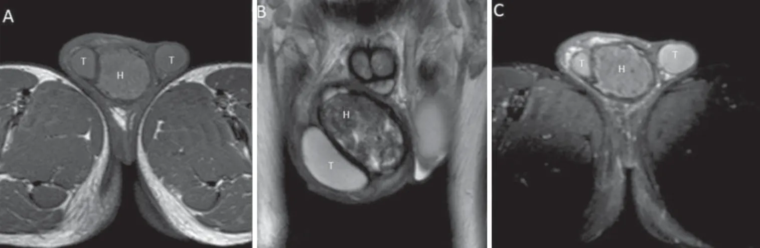 Figure 12. B-mode US image. Collection with multiple, incomplete septa inside, in a patient with hyperemia and pain in the scrotum.