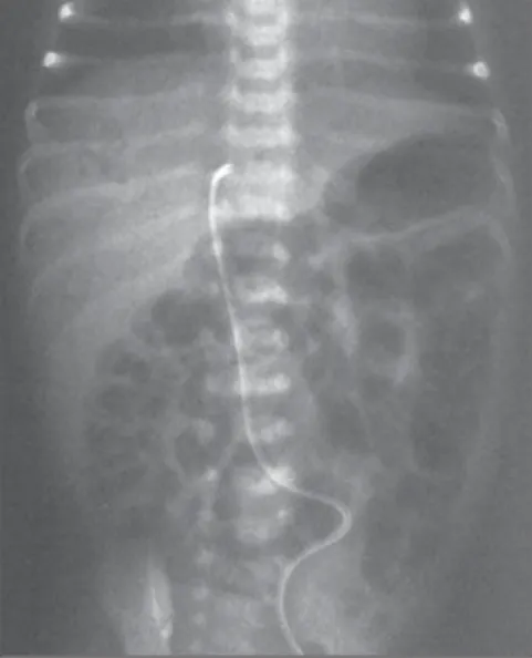 Figure 3. New radiography, performed approxi- approxi-mately 20 hours after, demonstrating that the air in the portal system had disappeared.