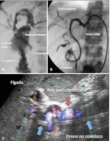 Figure 4. A: Percutaneous cholangiography demonstrating dilatation of the bil- bil-iary tract up to the common bile duct, with abrupt decrease in the caliber at the level of the middle third of the choledochus