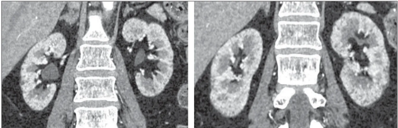 Figure 2. MRI, T2-weighted image demonstrating the presence of multiple microcysts with hypersignal distributed in both kidneys.