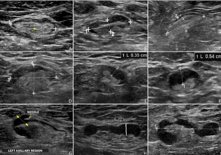 Figure 1. Sonographic images demonstrating some lymph nodes classified as morphologically normal (A–C) and indeterminate (D–I)