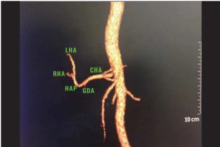 Figure 4. Contrast-enhanced CT with volume rendering identifying variation of the right hepatic artery (RHA) that emerges from the superior mesenteric artery (SMA).
