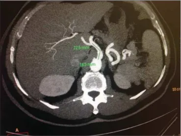 Figure 5. Axial, contrast-enhanced CT showing the longer length of the celiac trunk observed in the present study.