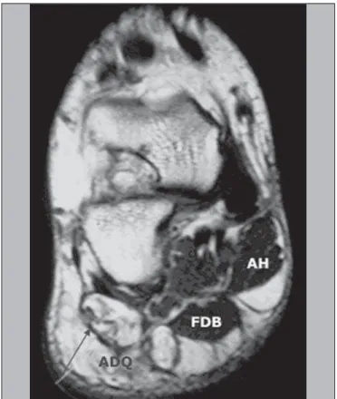 Figure 5. Sagittal MRI DP-weighted sequence with fat suppression showing signs of plantar fasciitis and abnormality in the signal of ADQ muscle fibers, that is hyperintense, corresponding to a pattern of edema resulting from acute  denerva-tion.