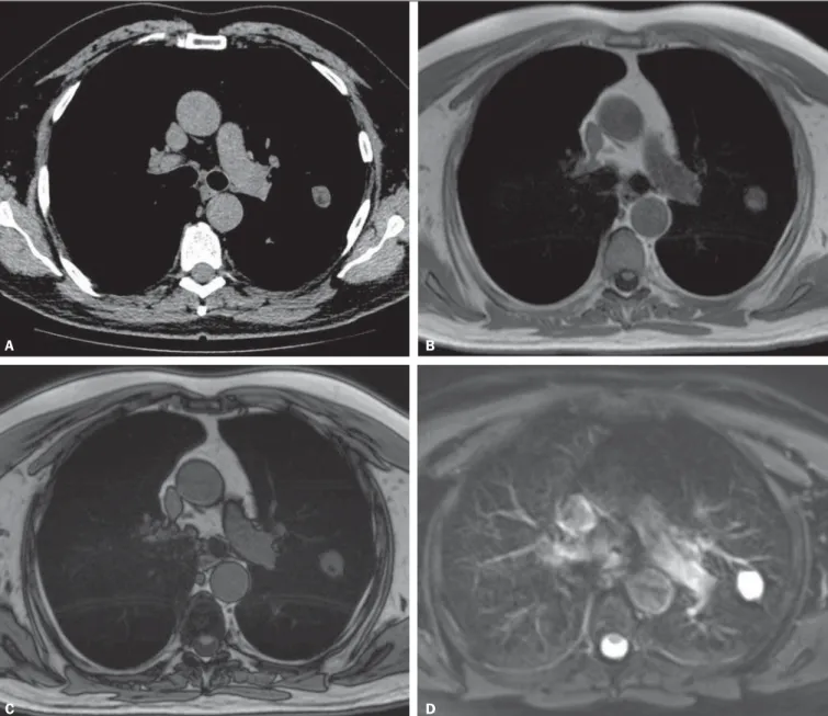 Figure 1. A 56-year-old patient with pancreatic cancer. A: Axial CT image showing low attenuation areas inside the nodule