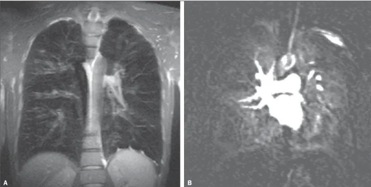 Figure 3. 3D volume rendering of MR angiography showing subsegmental reso- reso-lution.