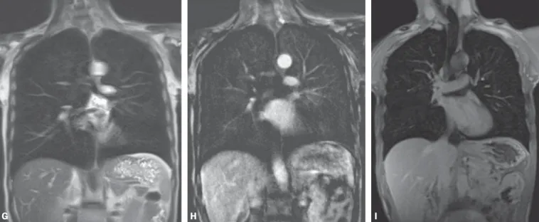 Figure 6 (G–I): Image examples for the suggested protocol. G: Coronal, T2-weighted HASTE sequence