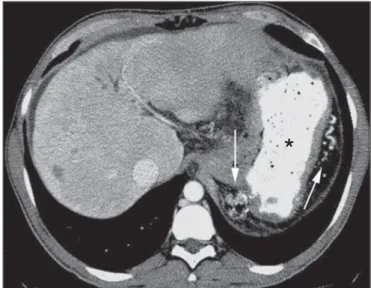 Figure 3. Cirrhotic patient with esophageal varices and hematemesis. In spite of extensive collateral circulation, well identified at CT (arrows), it is not possible to observe a possible active bleeding due to the presence of iodinated contrast medium in 