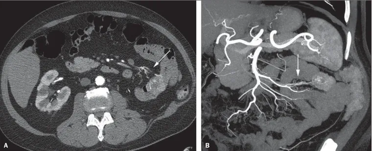 Figure 4. CT angiography in the arterial phase (A) and the corresponding angiographic MIP reconstruction (B)