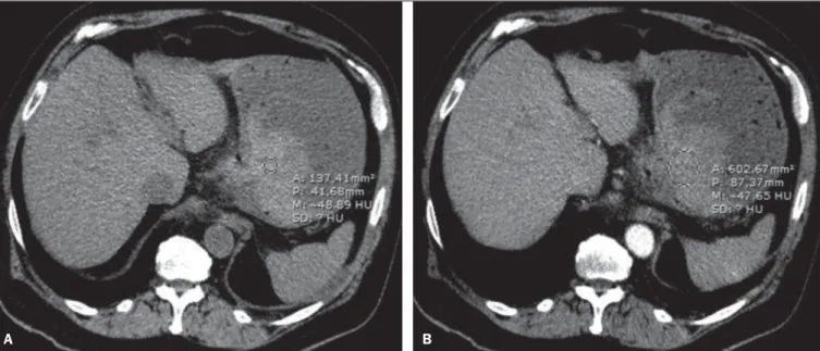 Figure 5. Abdominal CT angiography. Non-contrast-enhanced phase (A) and arterial phase (B)