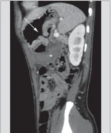 Figure 9. Non-contrast-enhanced CT angiography (A), in the arterial phase (B) and MIP reconstruction (C)