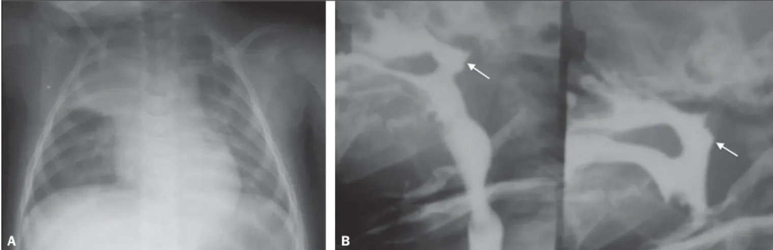 Figure 1. A neonate with encephalopathy caused by perinatal anoxia, presenting with respiratory symptoms