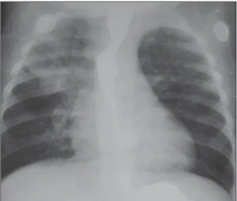 Figure 2. A three-month-old male child with neurological sequelae of congenital toxoplasmosis