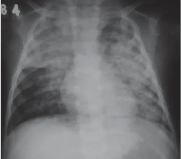 Figure 9. A six-year-old male child said to be asthmatic, presented with dyspnea and sudden chest pain