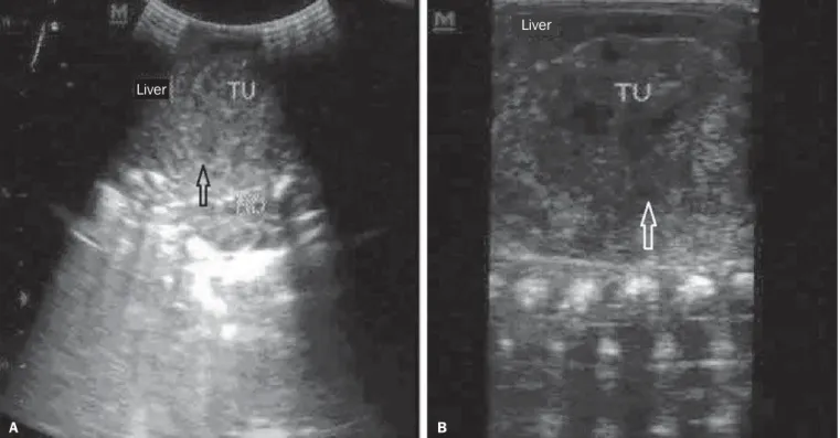 Figure 2. Abdominal computed tomography. A: Transverse section demonstrating the presence of a hypodense, solid mass measuring approximately 4 cm in diameter in the right renal locus (arrow)