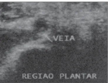 Figura 1. A: Sequência DP com satura- satura-ção da gordura demonstrando  espessa-mento parietal da veia plantar lateral,  as-sociado a edema perivascular (seta).