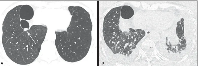 Figura 1. TCAR com corte ao nível das bases pulmonares (A) mostrando lesões bolhosas à direita, com pequena formação nodular medindo cerca de 0,8 cm de diâmetro no interior de uma das bolhas (seta)