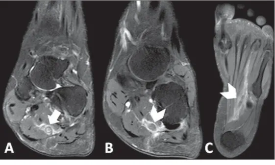 Figure 1. A: Proton density-weighted sequence with fat saturation  demonstrat-ing parietal thickendemonstrat-ing of lateral plantar vein in association with perivascular edema (arrow)