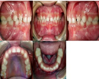 Figura 5. Fotografias  Intrabucais  finais:  A)lateral  direita  B)  Frontal C)Lateral Esquerdo D) oclusal superior E) Oclusal inferior.