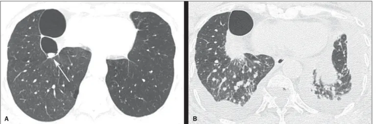 Figure 1. HRCT scan at the level of the lung bases (A) showing two bullae at right, with a small nodular mass measuring about 0.8 cm in diameter inside the small bulla (arrow)