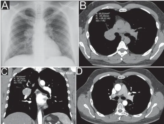 Figure 1. Chest radiography (A) show- show-ing ovoid opacity in the right hilar  re-gion