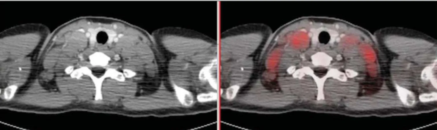 Figure 1. Pre-chemotherapy PET/CT image showing hypermetabolic lymph node enlargement in the cervical chains.