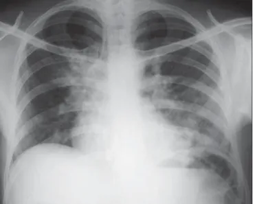 Figure 3. A 47-year-old man with a nodule (arrow) in the right lung.