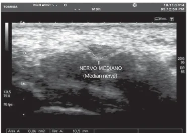 Figure 2. Cross section of the normal (delineated) median nerve area.