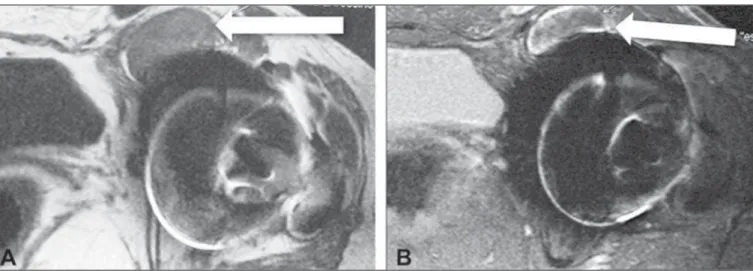 Figure 1. A: Axial, T1-weighted section demonstrating anterior collections adjacent to the joint (arrow), with hyperintense contents as compared with the bladder