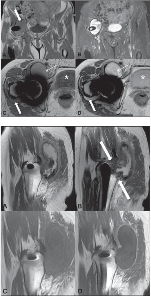 Figure 2. A: Coronal T1-weighted section show- show-ing the presence of a predominantly hyperintense collection (arrow) as compared with the bladder contents