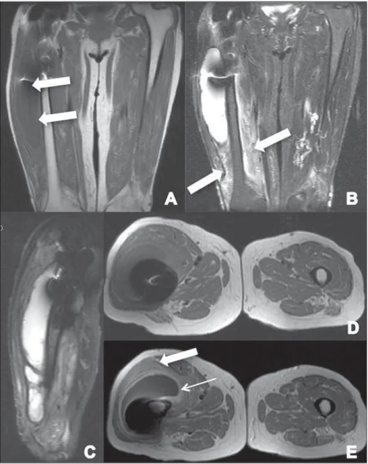 Figure 4. A: Coronal T1-weighted section show- show-ing the presence of a colleciton in the lateral aspect of the thigh, isointense to the muscle (arrows)
