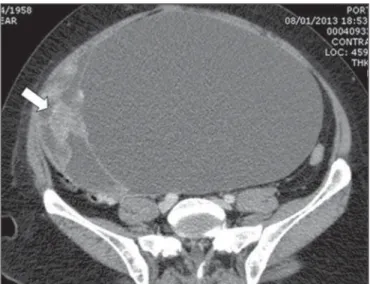 Figure 1. Voluminous complex cystic mass with solid component (arrow). Ab- Ab-sence of ascites at that moment.